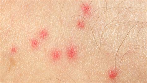 Mosquito Bite Allergie: sintomi e trattamento