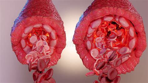 Vasoconstriction and Vasodilation Blood Pressure, Dilated Blood Vessels ...