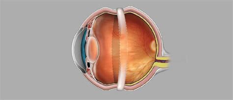 Scleral Buckle Retina Surgery – Devgiri Memorial Hospital