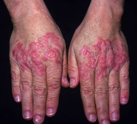 Lupus Systemic Lupus Erythematosus Sle Causes Sign