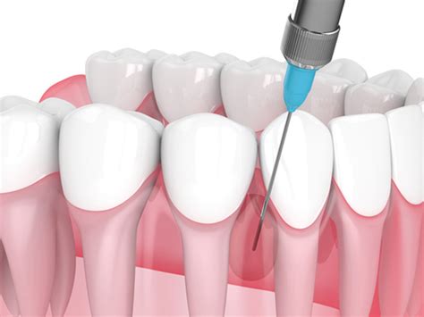 Septocaine (Articaine) Dental Local Anesthetic: Effects, Usage, Applications - Dental Didactics CE