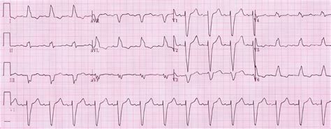 Left Bundle Branch Block Ekg Examples