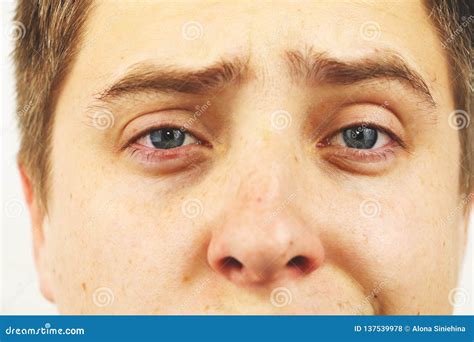 Conjunctivitis, Tired Eyes, Red Eyes, Eye Disease Stock Photo - Image of conjunctivitis, health ...