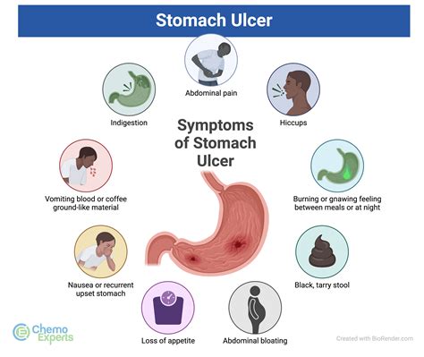 Stomach Ulcers | ChemoExperts