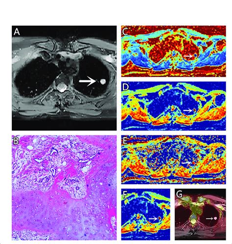 (A-G) A 51-year-old female patient, with hamartoma in the left lung,... | Download Scientific ...