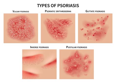 Psoriasis: Symptoms, Causes & Treatment - Affiliated Dermatology