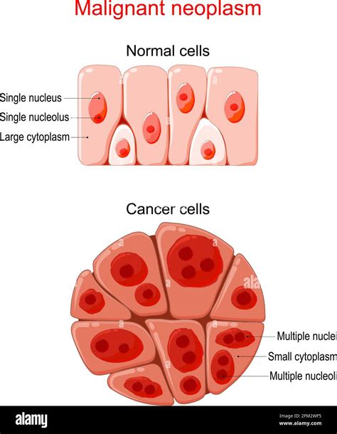 Malignant neoplasm. Cancer and Normal cells. comparison and difference between healthy tissue ...