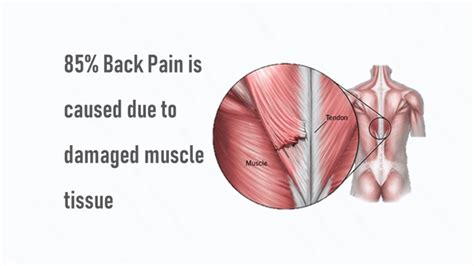 Lower Back Muscle Strain Treatment, Causes & Diagnosis | QI Spine