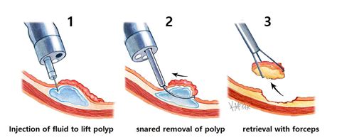 Polyps | Colorectal Surgeons Sydney