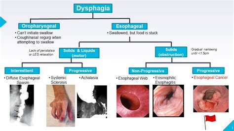 Dysphagia Diagram