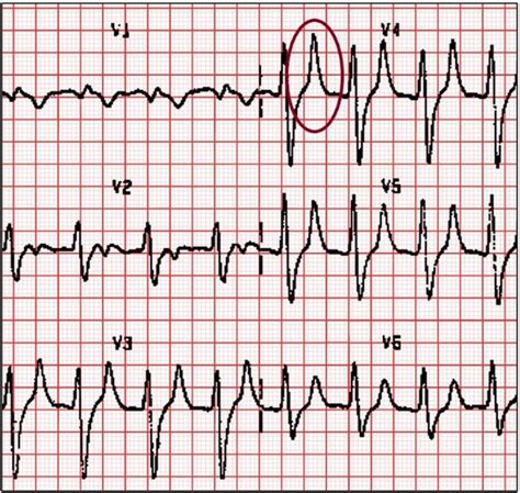 Tall Tented T Waves Hyperkalemia