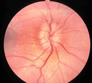 Papilledema - Definition, Pictures, Causes, Symptoms, Treatment