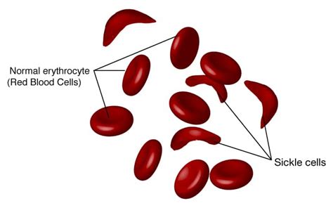 8 Types of Anemia | Based on the Blood cell Morphology & Causes