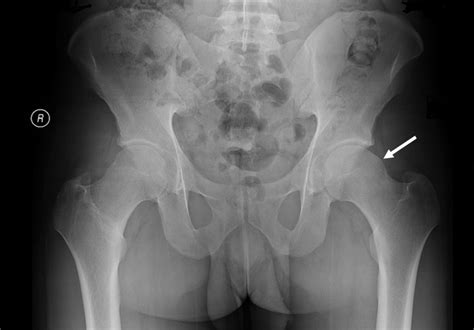 [Figure, AP pelvis x-ray demonstrating a...] - StatPearls - NCBI Bookshelf