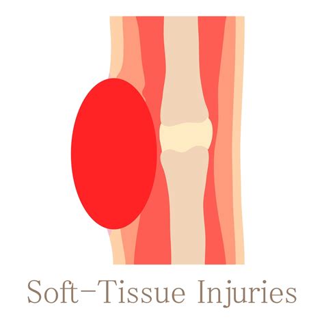 What Is a Soft Tissue Injury?