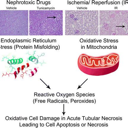 Acute kidney injury due to acute tubular necrosis. Acute tubular... | Download Scientific Diagram