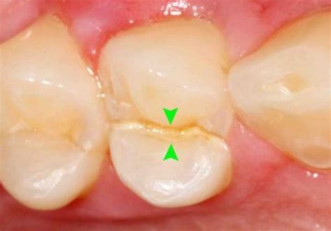 Chipped Tooth Repair | Cracked Tooth Repair: Advanced Endodontics