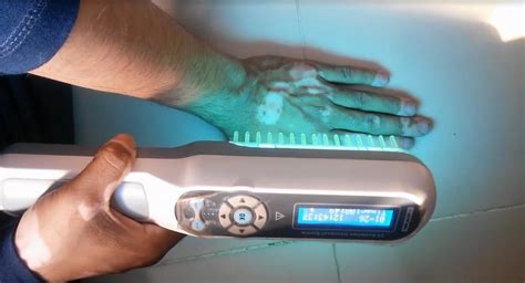 Narrowband UVB Phototherapy: Shine that Light! - Rochester Hills Dermatologist Dr. Arjun Dupati