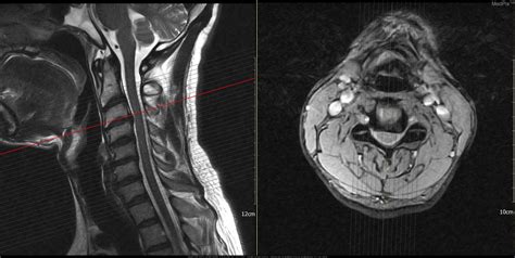 Disc Herniation Mri