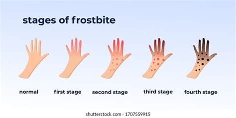 Frostbite Stock Photos - 6,058 Images | Shutterstock