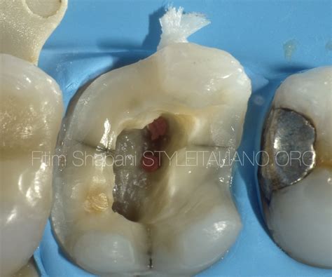 Treatment of a cracked tooth - Style Italiano Endodontics