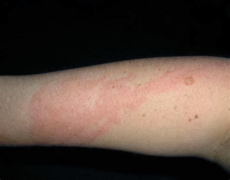 Poison Ivy Rash - Pictures, Treatment, Symptoms, Contagious, Duration