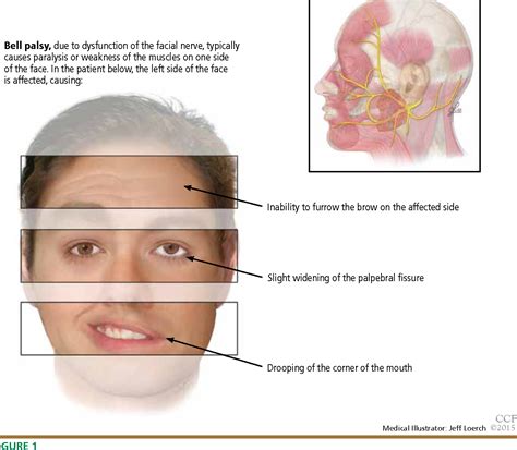 Figure 1 from Bell palsy: Clinical examination and management ...