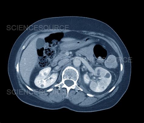 Photograph | Pyelonephritis, axial CT scan | Science Source Images