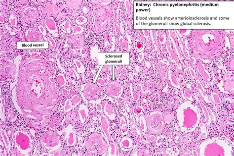 Acute Pyelonephritis Histology