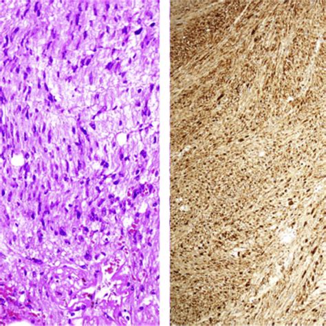 a and 1b: CT scanning showing RT Pyonephrosis with multiple stones and ...