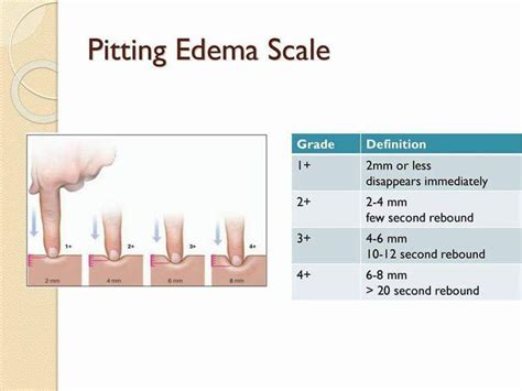 Pitting Edema Timing Scale