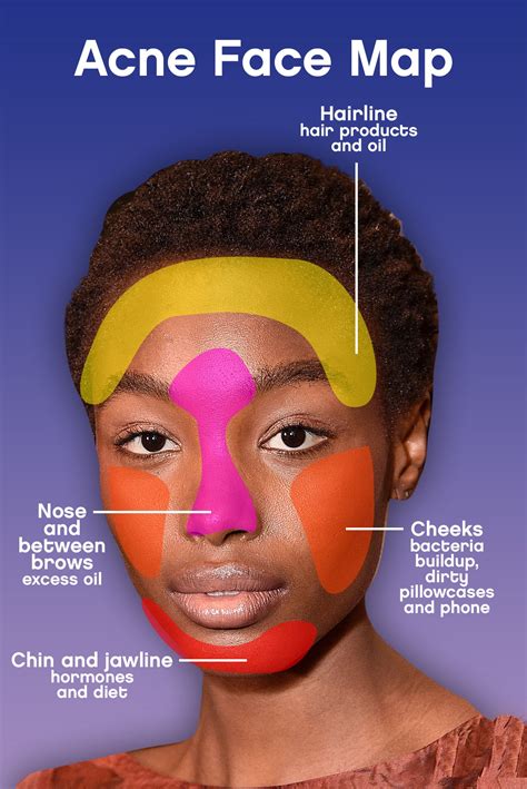 Acne Face Map: Here’s Why You’re Breaking Out | Glamour