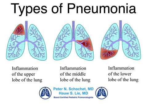 Dr Schochet Types of Pneumonia - Pediatric Pulmonologists