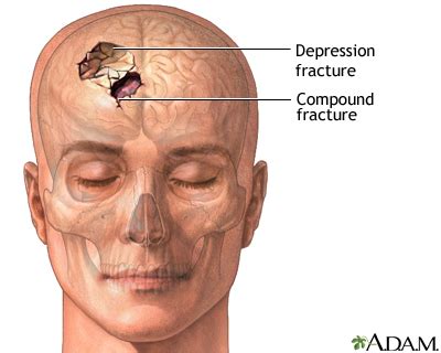 Skull fracture Information | Mount Sinai - New York