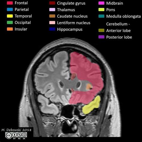 Brain lobes - annotated MRI | Radiology Case | Radiopaedia.org | Radiology, Radiology student ...