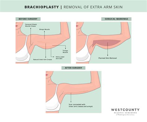 Arm Lift | St. Louis, MO | West County Plastic Surgeons