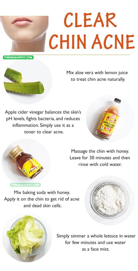 25+ bästa Chin acne causes idéerna på Pinterest