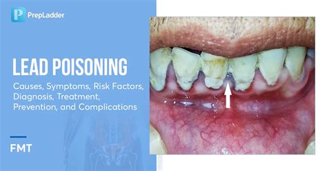 Lead Poisoning: Causes, Symptoms, Risk Factors, Diagnosis