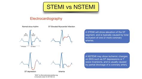 STEMI V NSTEMI Ausmed The Difference Between A STEMI And An, 55% OFF