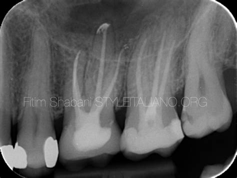 Treatment of a cracked tooth - Style Italiano Endodontics