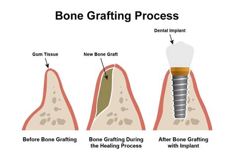 Candidate for a Dental Bone Grafting - Lincoln, NE