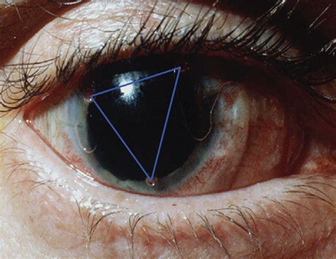 Preventing and Managing Edema with Scleral Lenses