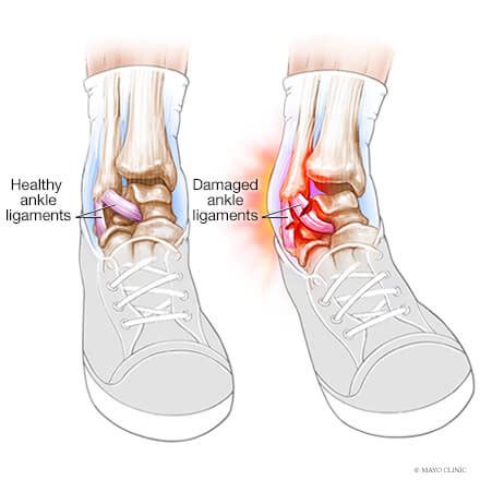 Ankle sprain - Overview - Mayo Clinic Orthopedics & Sports Medicine