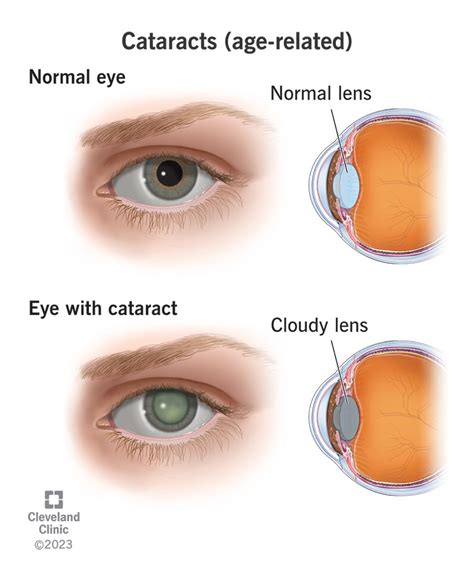 Understanding Cataract: Causes, Symptoms, And Treatment - Ask The Nurse ...