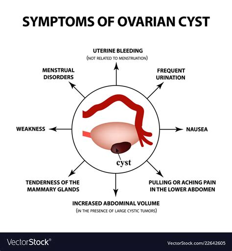 Ovarian Cysts Fatal Signs And Symptoms Of Ovarian Cyst, 57% OFF