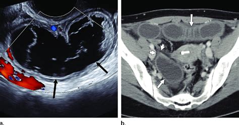 Broad ligament internal hernia in a 37-year-old woman who presented ...