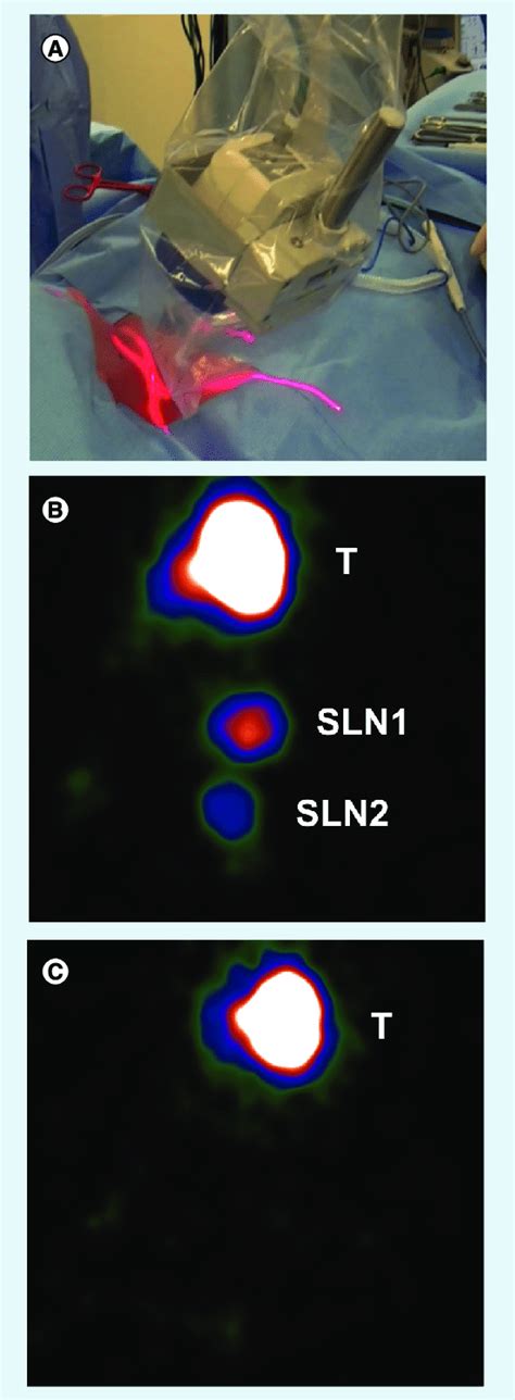 Mobile-camera detection of the sentinel lymph node(s) during sentinel... | Download High-Quality ...