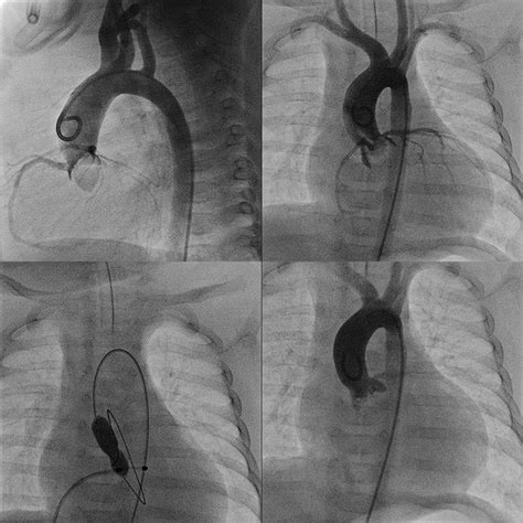 7 Intracardiac echocardiography for evaluation of the pulmonary valve.... | Download Scientific ...