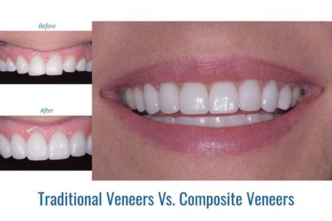 Good Veneers Vs Bad Veneers