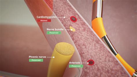 Medical Device Animation: Farapulse Pulsed Field Ablation (PFA) System - Medical Animation ...